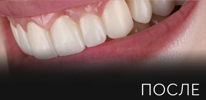 После: Восстановление после утраты зубов