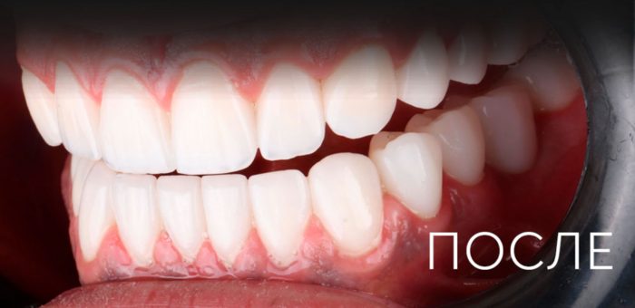 После: Имплантация в жевательном отделе